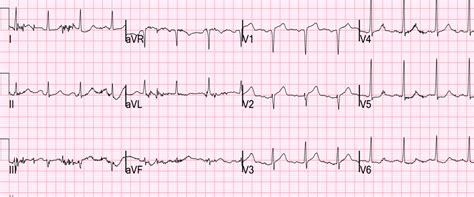 Dr Smiths Ecg Blog Septal Stemi With Lateral St Depression Then Has