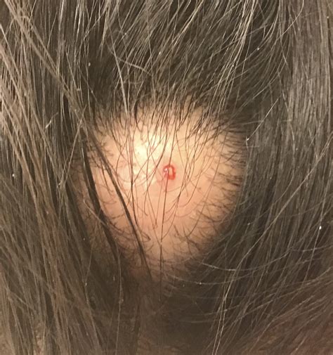 Sebaceous Cyst Scalp