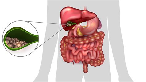 Cholécystite symptômes et traitement chez l adulte d une forme