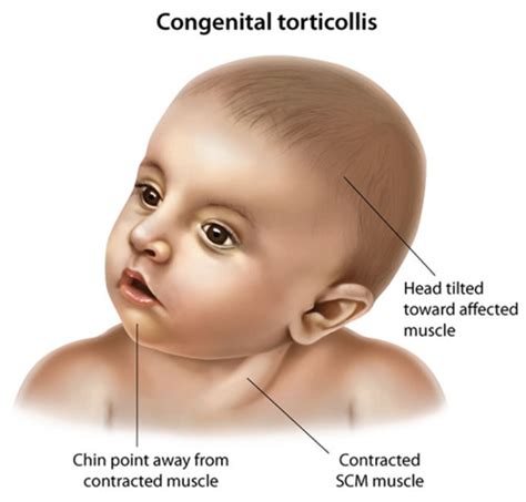 Pediatrics Ortho Final Exam Flashcards Quizlet