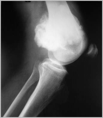 Soft Tissue Calcifications