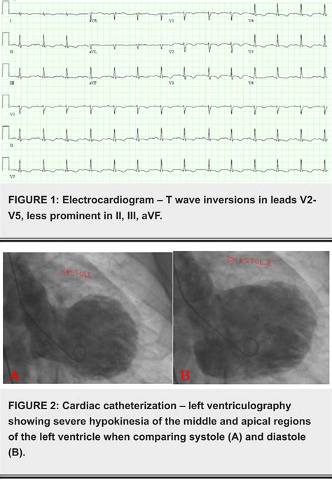 Figure 1 From Risk Factors And Management Of Takotsubo Cardiomyopathy Semantic Scholar