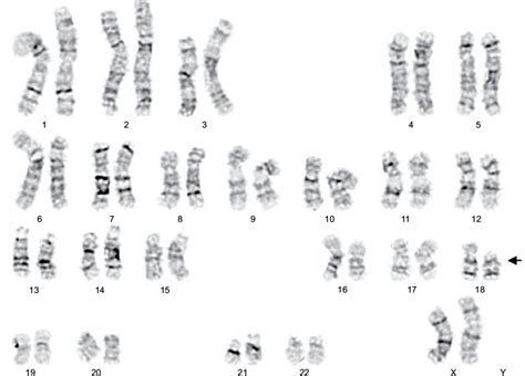 A Case Of 18p Deletion Syndrome After Blepharoplasty Imcrj