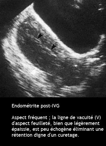 Anomalies De La Cavit Ut Rine Dr Kara Zaitri M A