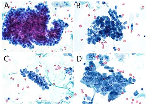 Transitional Cell Carcinoma Cytology