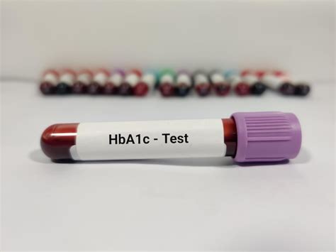 Tubo De Ensayo Con Muestra De Sangre Para La Prueba De Hba C Foto Premium