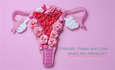 Uterine Polyps