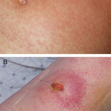 Typical clinical manifestations of acute African trypanosomiasis ...