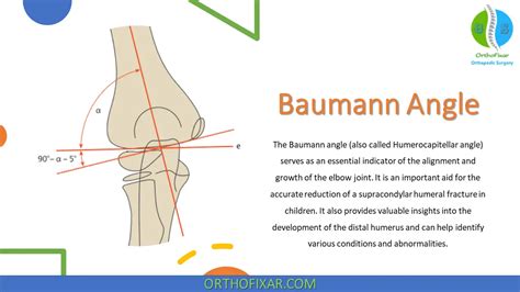 Baumann Angle For Elbow Joint Alignment OrthoFixar 2025