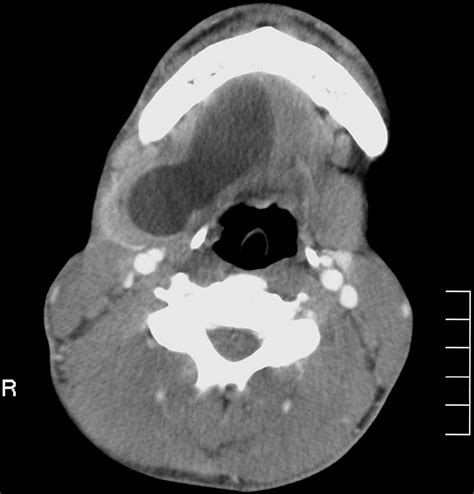 Lateral Dermoid Cyst British Journal Of Oral And Maxillofacial Surgery