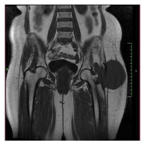 Axial T1 And T2 Weighted Mri Image Of The Pelvis Showing The Abscess Download Scientific