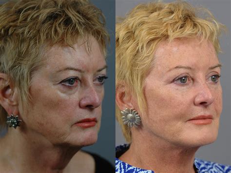 Facial Rejuvenation Before After Patient 27 Dr Marotta