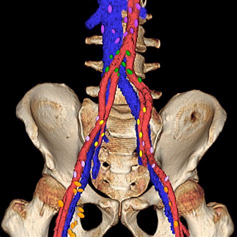 Para Aortic Pathway Of Nodal Drainage Gray Arrows Metastatic Disease