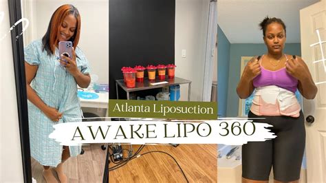 Awake Liposuction Plus Bra Rolls Youtube