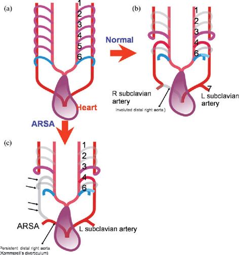 Figure 1 From Non Invasive Imaging Of Aberrant Right Subclavian Artery