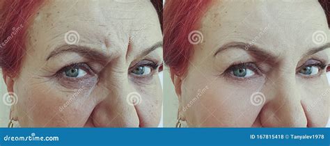 Face De Uma Mulher Idosa Ruga Antes E Depois Do Tratamento Foto De