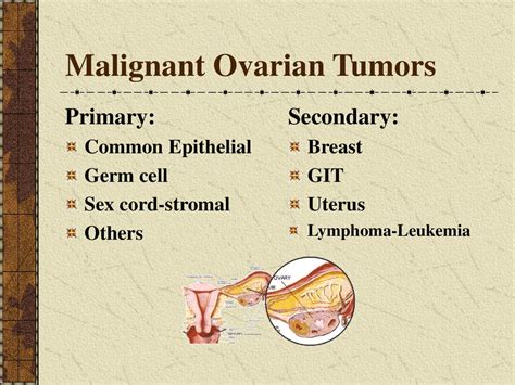 Malignant Ovarian Neoplasms Ppt Download