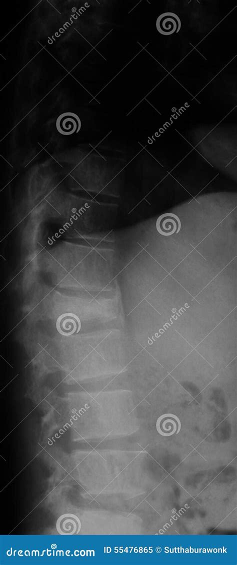 X Ray Ls Spine Lateral View Showing Burst Fracture Of L2 Vertebral Body With Severe Vertebral