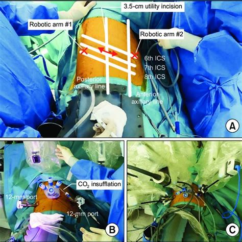 Robotic Right Lower Lobe Rll Lobectomy A Division Of The Inferior