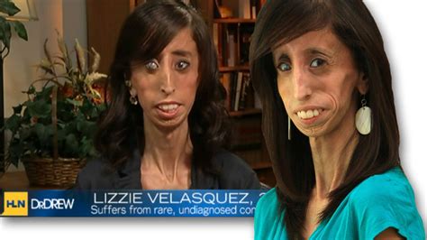 Lizzie Velasquez Answers Bullies Who Branded Her The Worlds Ugliest