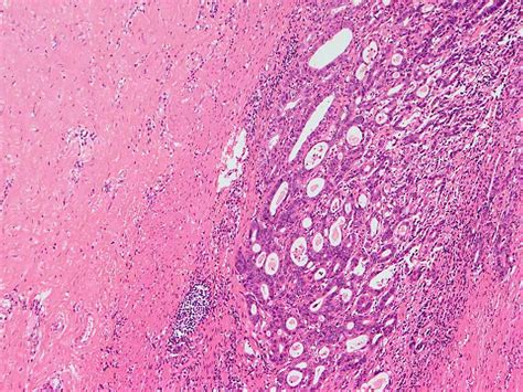 Frontiers Case Report A Case Of Delayed Cutaneous Metastases From