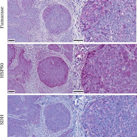 Serous Papillary Ovarian Cancer Treated With Hsp60 Download