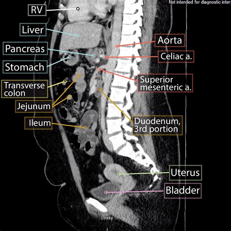 Gross Anatomy Glossary Sagittal Abdominal Ct Ditki Medical And Biological Sciences