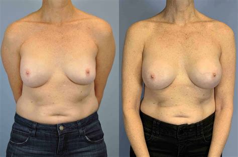 Breast Reconstruction Gallery Dr Paul Vanek