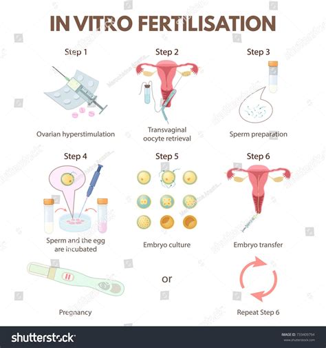 In Vitro Fertilization Step By Step Method The Stages Of Artificial Insemination Ivfstepmethod