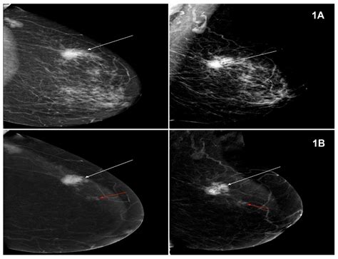 Current Oncology Free Full Text The Usefulness Of Spectral Mammography In Surgical Planning