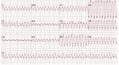 Pediatric Cardiopulmonary Arrest And Post Arrest Care Relias Media