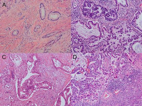 Genetic Characteristics Of Gastric Type Mucinous Carcinoma Of The Uterine Cervix Modern Pathology