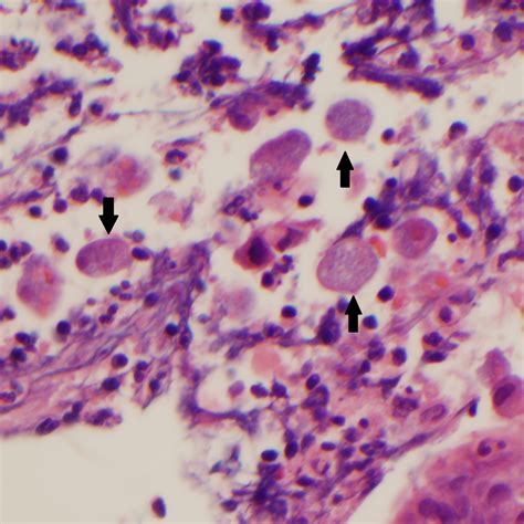 Pdf Amoebic Liver Abscess