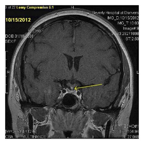 Mri Shows Absence Of Posterior Pituitary Bright Spot A And Thickened