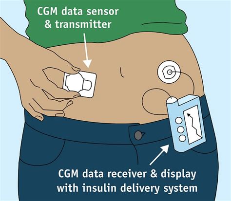 7 4 Subcutaneous Injections Clinical Procedures For Safer Patient Care