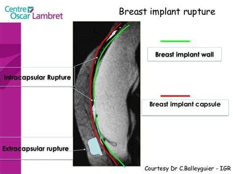 Sophie Taieb Breast Mri Indication 2014