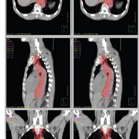 Continued A Dose Distributions Of VMAT Left And IMRT Right For