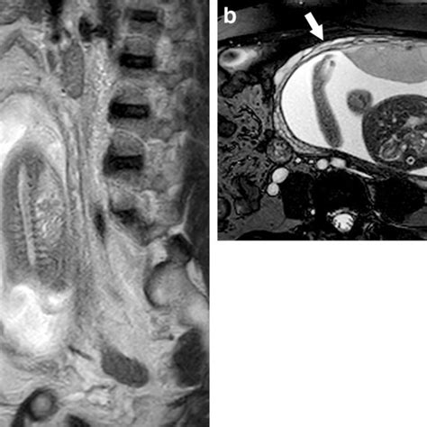 Multiple Variant Configurations Of Placental Parenchyma On Mri In