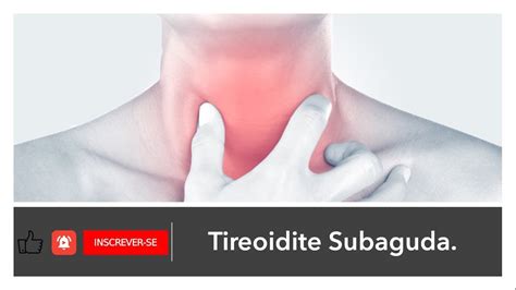 Tireoidite Subaguda 009 YouTube