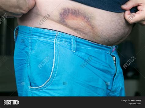 Bruise, Hematoma On Image & Photo (Free Trial) | Bigstock