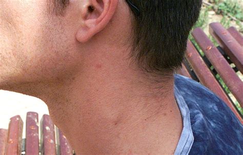 ¿por Qué Tengo Un Bulto En El Cuello Y En Qué Casos Debo Ir Al Médico