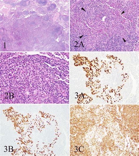 High Power View Of The Pulmonary Lymphoepithelioma Like Carcinoma Shows