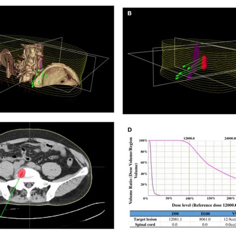 Iodine 125 125 I Brachytherapy Treatment Plan For Bone Metastases Download Scientific