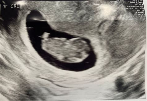 9 Week Ultrasound Can You Tell Gender Babycenter