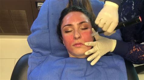 Microneedling With Prp Platelet Rich Plasma Vampire Facial Youtube