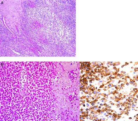 Histological Appearance Of Neoplasia A Round Cells With Round Nuclei
