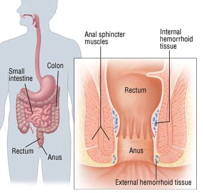 Anal Fissure Or Hemorrhoid