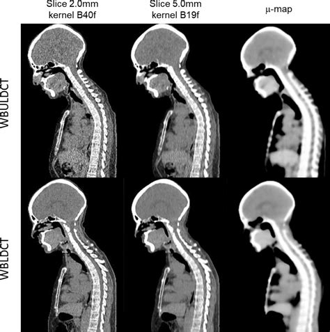 Ultra Low Dose Whole Body Ct For Attenuation Correction In A Dual