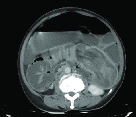 Computed Tomography Scan Showing Transverse Sausage Shaped Colo Colic Download Scientific