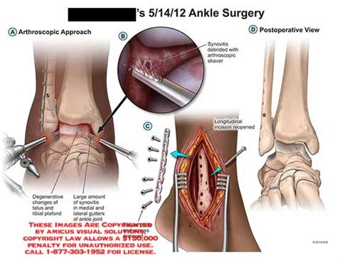 Amicus Illustration Of Amicus Surgery Arthroscopic Degenerative Talus